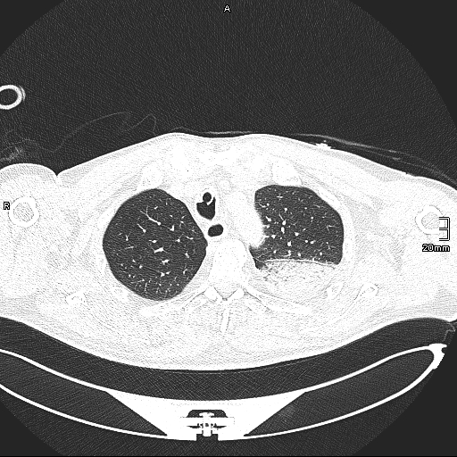 Acute aspiration pneumonitis (Radiopaedia 55642-62166 Axial lung window 40).jpg