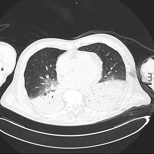 Acute aspiration pneumonitis (Radiopaedia 55642-62166 Axial lung window 97).jpg