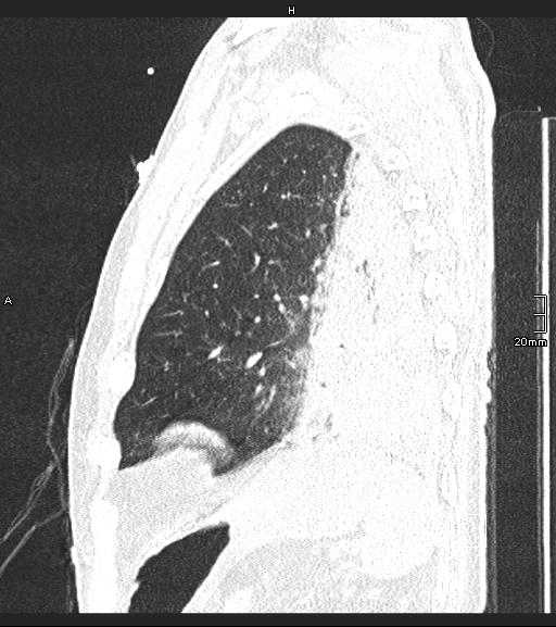 Acute aspiration pneumonitis (Radiopaedia 55642-62166 Sagittal lung window 24).jpg