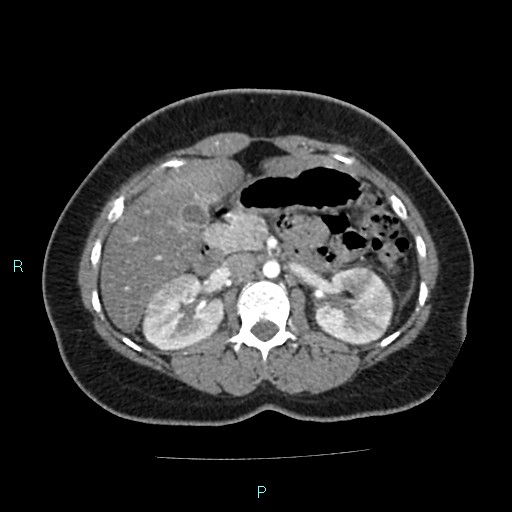 Acute bilateral pyelonephritis (Radiopaedia 37146-38881 Axial C+ arterial phase 72).jpg