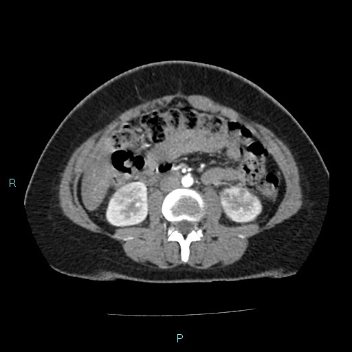 Acute bilateral pyelonephritis (Radiopaedia 37146-38881 Axial C+ arterial phase 98).jpg