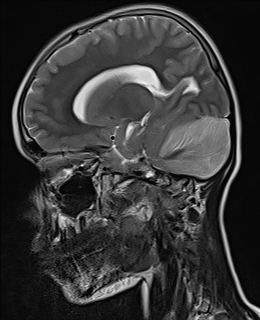 File:Acute cerebellar ataxia (Radiopaedia 61487-69446 Sagittal T2 9).jpg