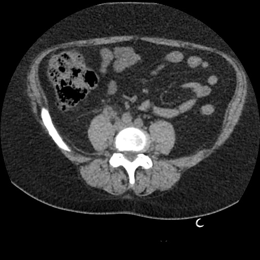 Acute cholecystitis and ureteric colic (Radiopaedia 42330-45444 Axial prone 64).jpg