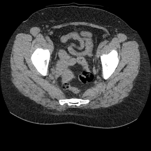 File:Acute cholecystitis and ureteric colic (Radiopaedia 42330-45444 Axial prone 96).jpg