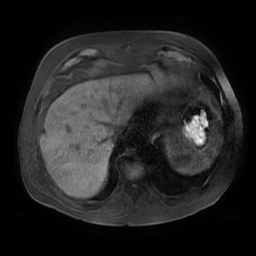 File:Acute cholecystitis complicated by pylephlebitis (Radiopaedia 65782-74915 Axial T1 fat sat 12).jpg