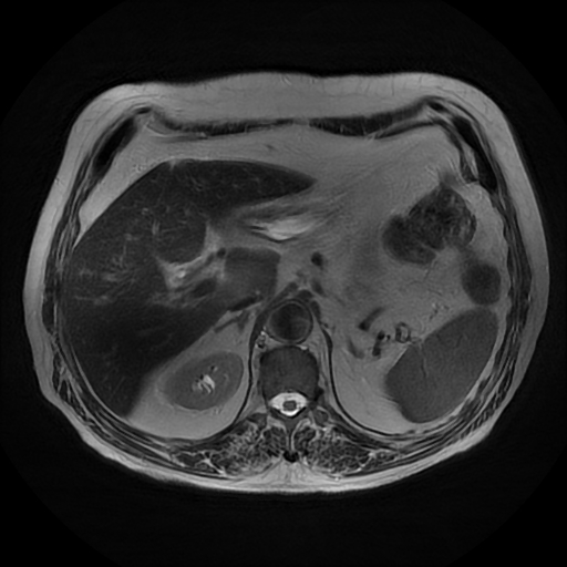 File:Acute cholecystitis complicated by pylephlebitis (Radiopaedia 65782-74915 Axial T2 15).jpg