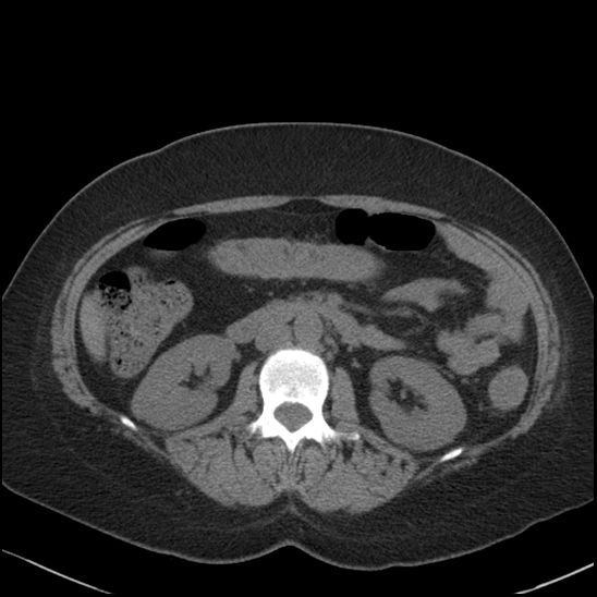 Acute colonic hemorrhage in ulcerative colitis (Radiopaedia 77415-89538 Axial non-contrast 58).jpg