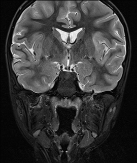 File:Acute disseminating encephalomyelitis with bilateral optic neuritis (Radiopaedia 79676-92886 Coronal STIR 18).jpg