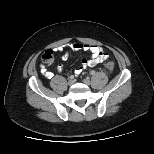 Acute diverticulitis with localized perforation (Radiopaedia 41296-44113 Axial C+ portal venous phase 65).jpg