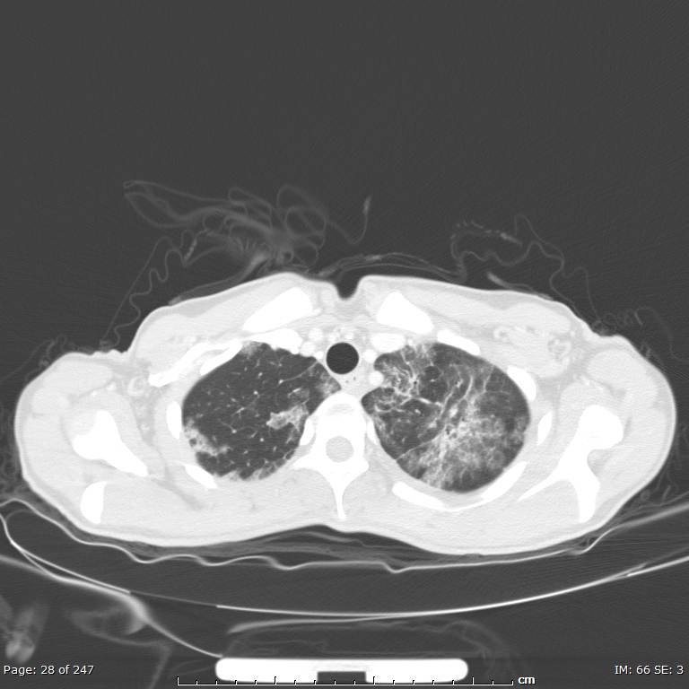 Acute eosinophilic pneumonia (Radiopaedia 48211-53073 Axial lung window 10).jpg