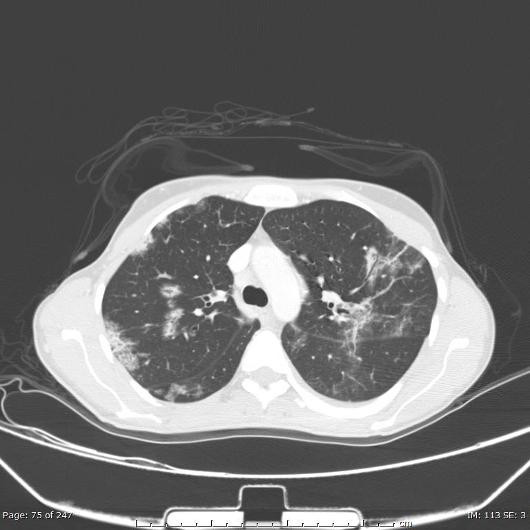 Acute eosinophilic pneumonia (Radiopaedia 48211-53073 Axial lung window 27).jpg