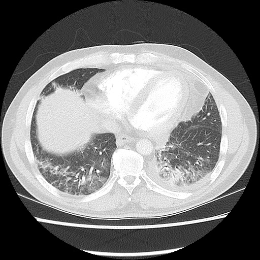 Acute epicardial fat necrosis (Radiopaedia 42327-45440 Axial lung window 41).jpg