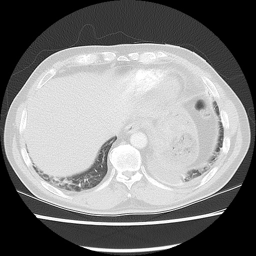 Acute epicardial fat necrosis (Radiopaedia 42327-45440 Axial lung window 46).jpg
