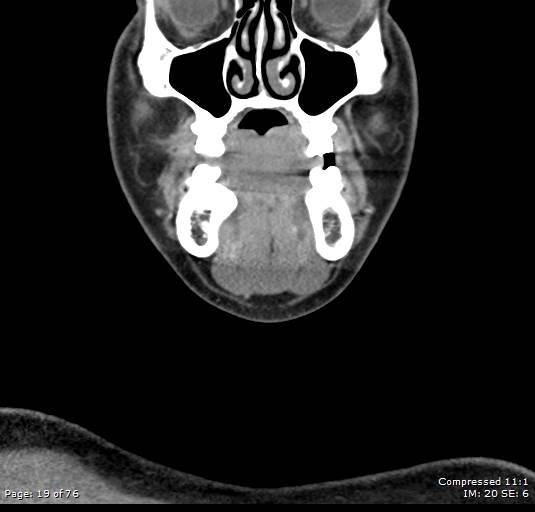 Acute epiglottitis (Radiopaedia 54375-60590 Coronal C+ arterial phase 19).jpg