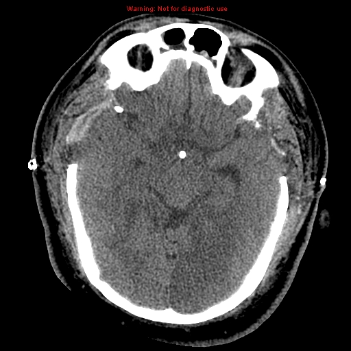 Acute hemorrhagic leukoencephalitis (Radiopaedia 14076-43697 Axial non-contrast 20).jpg