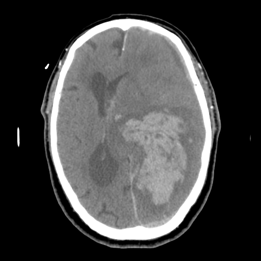 Acute hemorrhagic stroke (Radiopaedia 17507-17223 Axial non-contrast 29).jpg