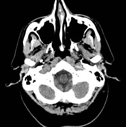 Acute internal carotid artery dissection (Radiopaedia 53541-59558 Axial non-contrast 7).jpg