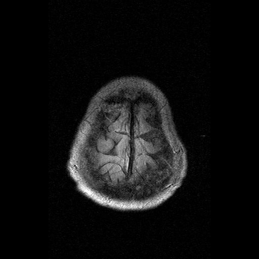 File:Acute necrotizing toxoplasma encephalitis (Radiopaedia 10683-11149 Axial FLAIR 1).jpg