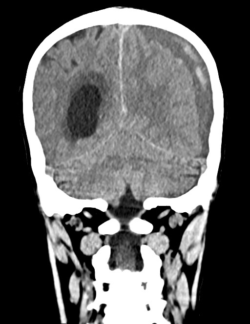 Acute on chronic subdural hematoma (Radiopaedia 74814-85823 Coronal non-contrast 47).jpg