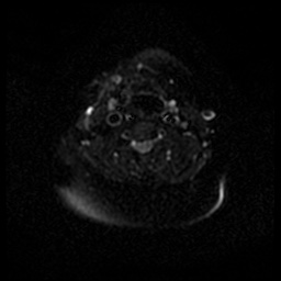 Acute otitis externa (Radiopaedia 57296-64236 Axial DWI 53).jpg