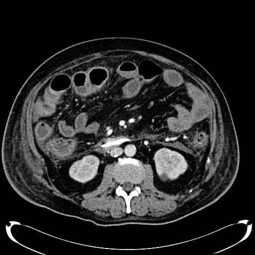 Acute pancreatic necrosis (Radiopaedia 13560-18500 Axial C+ portal venous phase 80).jpg