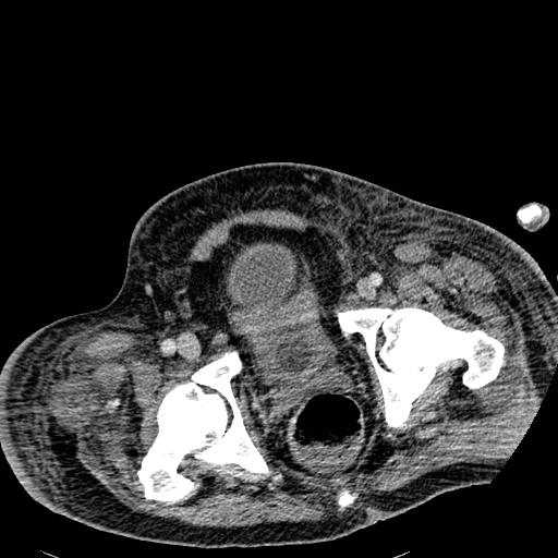 Acute pancreatic necrosis (Radiopaedia 13560-18501 Axial C+ portal venous phase 142).jpg