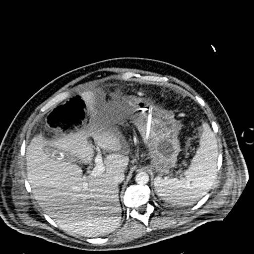 Acute pancreatic necrosis (Radiopaedia 13560-18501 Axial C+ portal venous phase 29).jpg
