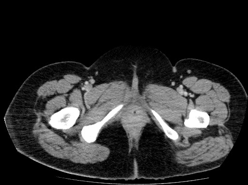 File:Acute pancreatitis (Radiopaedia 69236-79012 Axial C+ portal venous phase 93).jpg