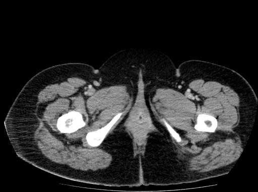 Acute pancreatitis (Radiopaedia 69236-79012 Axial C+ portal venous phase 94).jpg