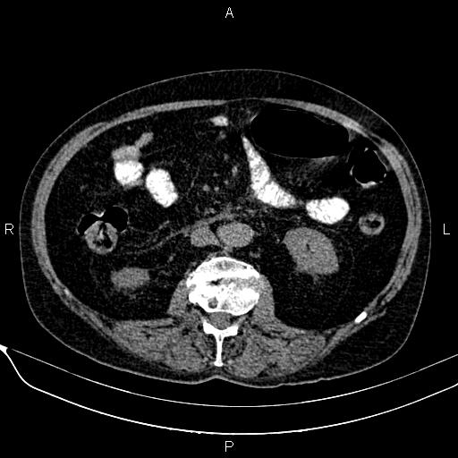Acute pancreatitis (Radiopaedia 85146-100701 Axial non-contrast 63).jpg