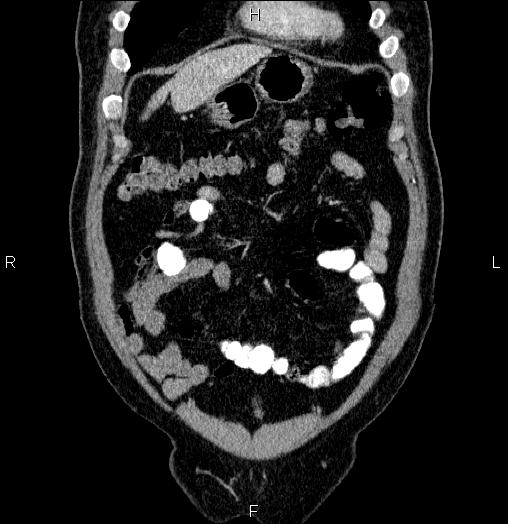 Acute pancreatitis (Radiopaedia 85390-101010 Coronal C+ portal venous phase 11).jpg