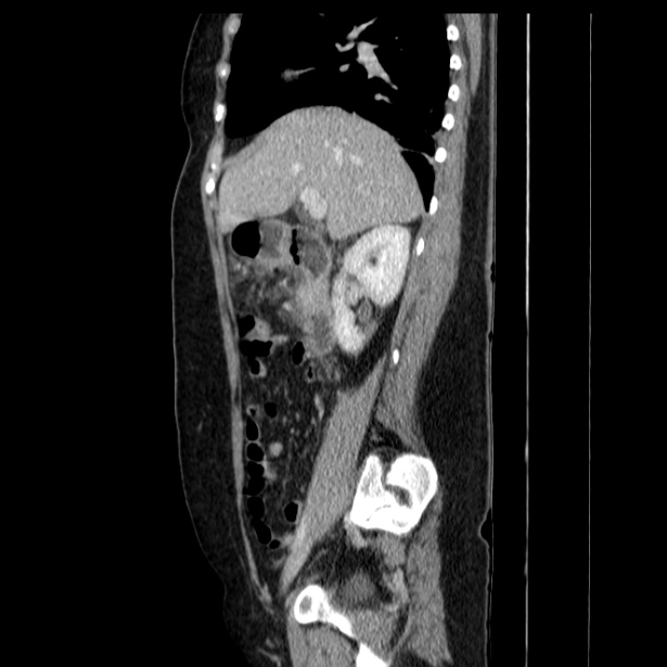 Acute pancreatitis - Balthazar C (Radiopaedia 26569-26714 Sagittal C+ portal venous phase 26).jpg