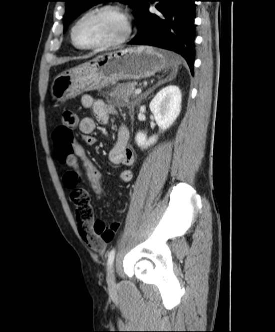 Acute pancreatitis - Balthazar E (Radiopaedia 23080-23110 Sagittal C+ portal venous phase 69).jpg