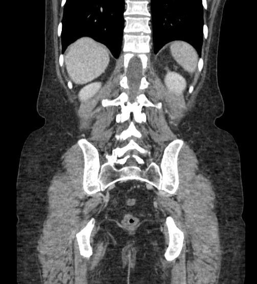 Acute pancreatitis - Balthazar E - post ERCP (Radiopaedia 27562-27772 Coronal C+ portal venous phase 70).png