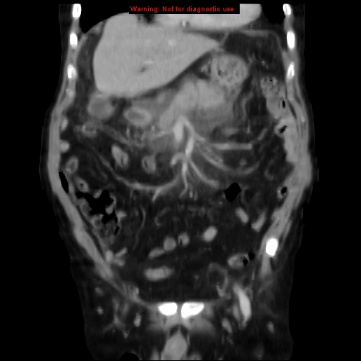 Acute pancreatitis with incidental pancreatic lipoma (Radiopaedia 10190-10730 Coronal C+ portal venous phase 23).jpg