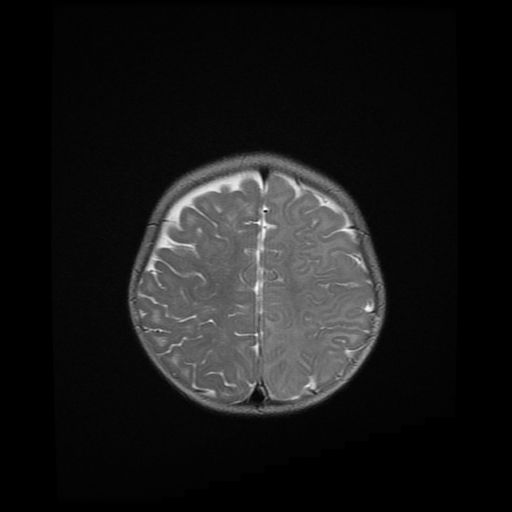 File:Acute phase of hemiconvulsion-hemiplegia epilepsy syndrome (Radiopaedia 29309-29745 Axial T2 6).jpg