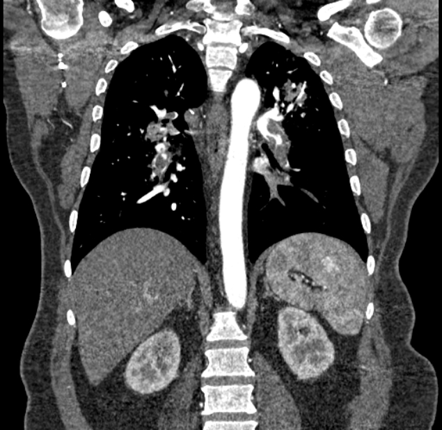 Acute pulmonary embolism with pulmonary infarcts (Radiopaedia 77688-89908 Coronal C+ CTPA 64).jpg