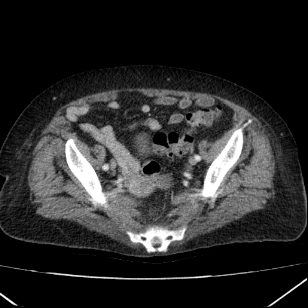 Acute pyelonephritis (Radiopaedia 26584-26729 Axial renal cortical phase 61).jpg
