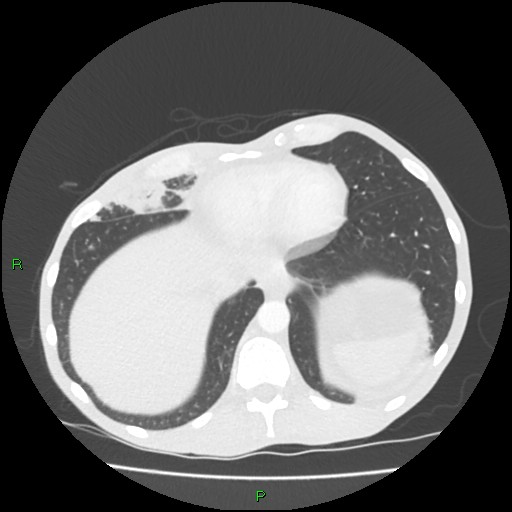 Acute right lung abscess (Radiopaedia 34806-36258 Axial lung window 155).jpg