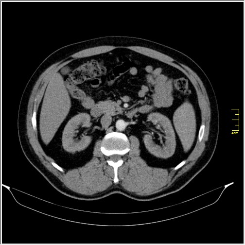 File:Acute right sided diverticulitis (Radiopaedia 65249-74268 Axial C+ portal venous phase 30).JPG