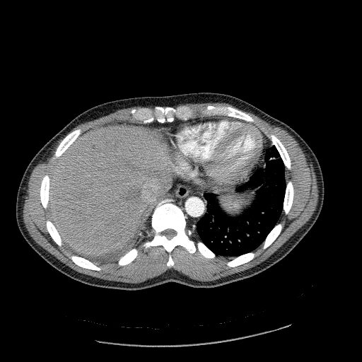 Acute segmental pulmonary emboli and pulmonary infarction (Radiopaedia 62264-70444 Axial C+ CTPA 92).jpg