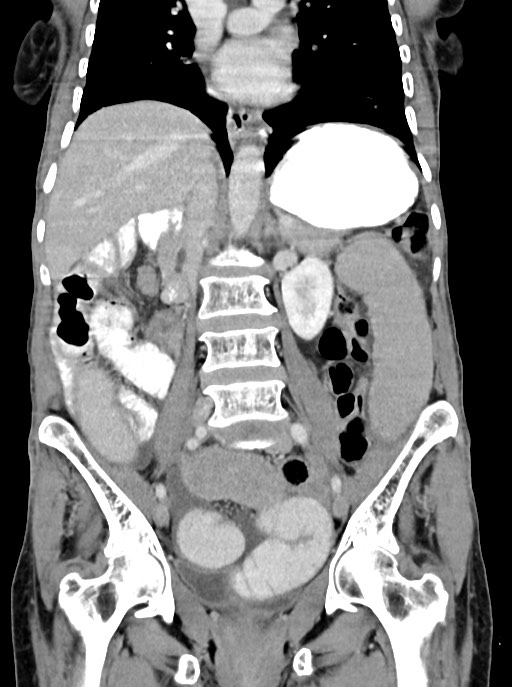 Acute small bowel (ileal) volvulus (Radiopaedia 71740-82139 Coronal C+ portal venous phase 63).jpg