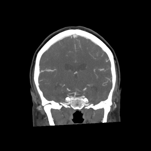 File:Acute subarachnoid hemorrhage and accessory anterior cerebral artery (Radiopaedia 69231-79009 Coronal C+ arterial phase 45).jpg