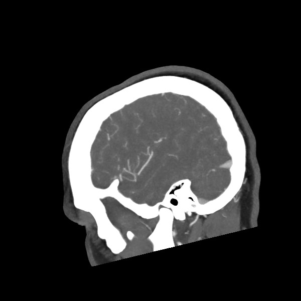 Acute subarachnoid hemorrhage and accessory anterior cerebral artery (Radiopaedia 69231-79009 Sagittal C+ arterial phase 17).jpg