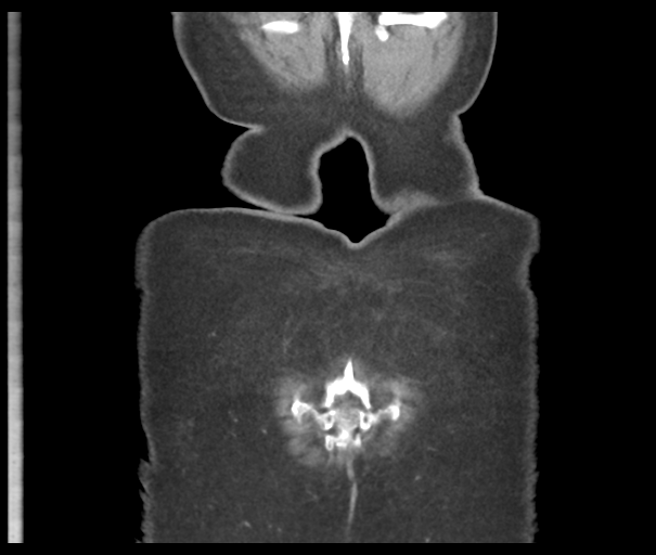 Acute superior mesenteric artery occlusion (Radiopaedia 43926-47418 Coronal C+ portal venous phase 50).png