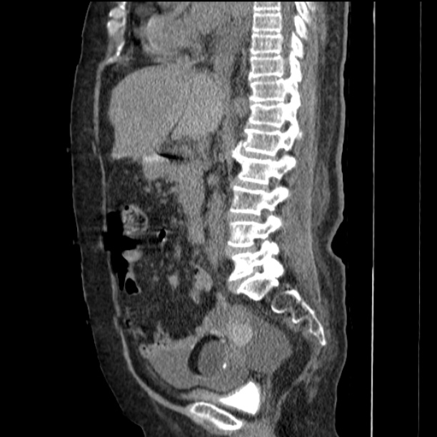 Acute tubular necrosis (Radiopaedia 28077-28334 Sagittal non-contrast 43).jpg