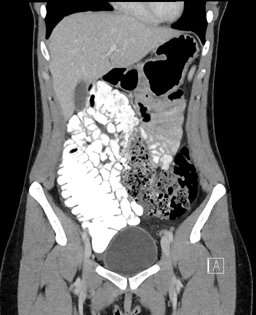 Acute uncomplicated appendicitis (Radiopaedia 61374-69304 Coronal C+ portal venous phase 31).jpg