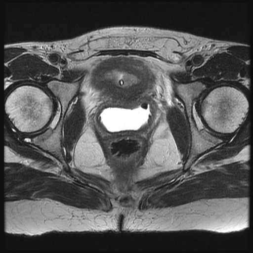 File:Adenocarcinoma arising in a urethral diverticulum (Radiopaedia 12400-12657 Axial T2 10).jpg
