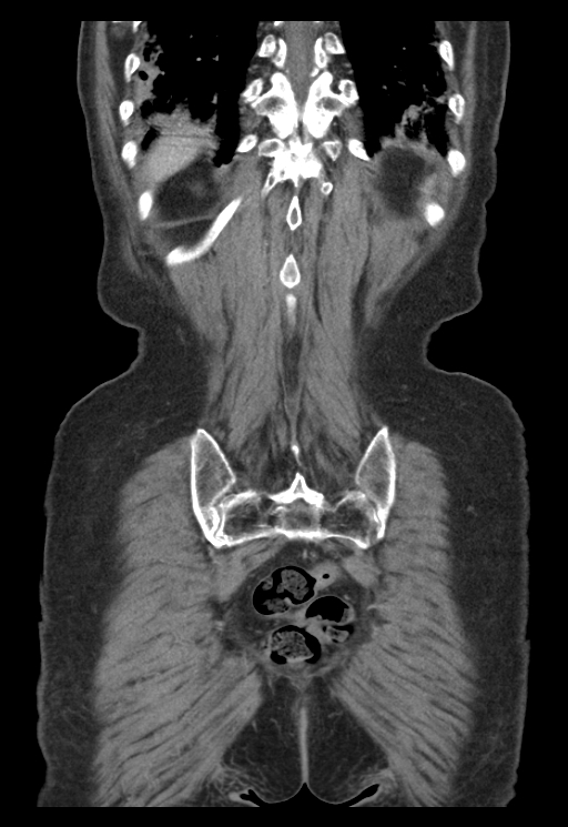 Adenocarcinoma of cecum (Radiopaedia 59222-66549 Coronal C+ portal venous phase 62).jpg