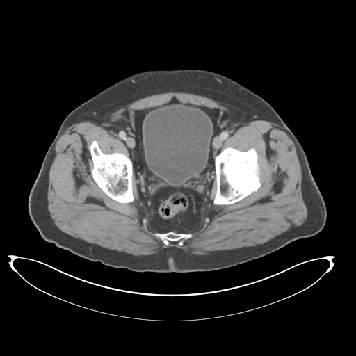 Adenocarcioma of rectum- T1 lesion (Radiopaedia 36921-38547 Axial C+ portal venous phase 80).png